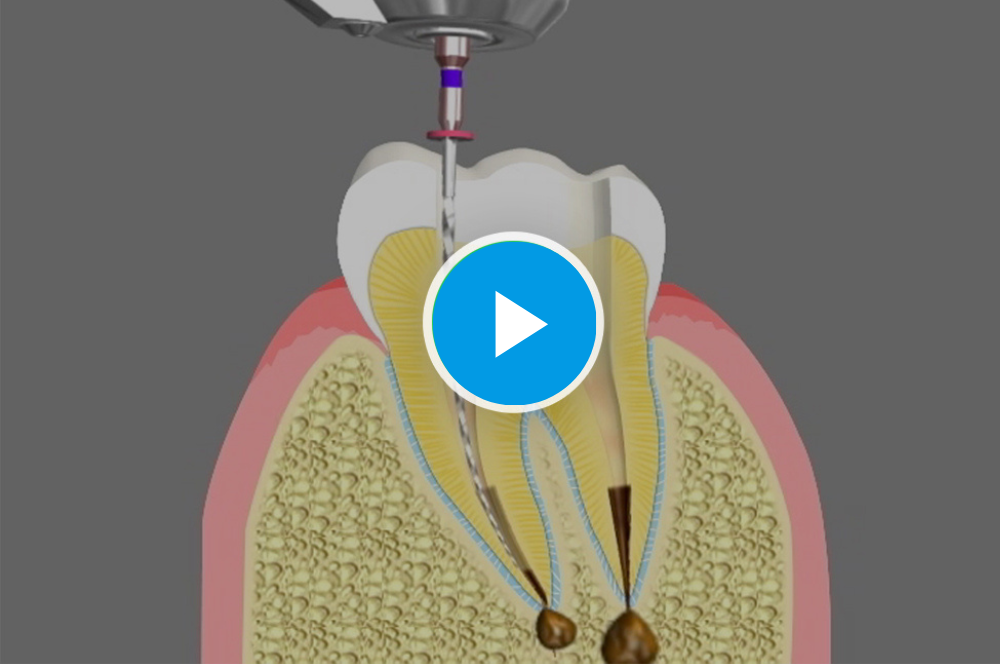 Root Canal Therapy