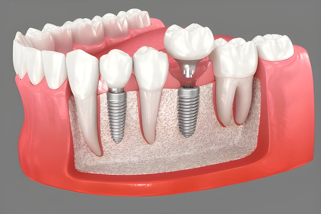 dental implants in sw calgary, ab