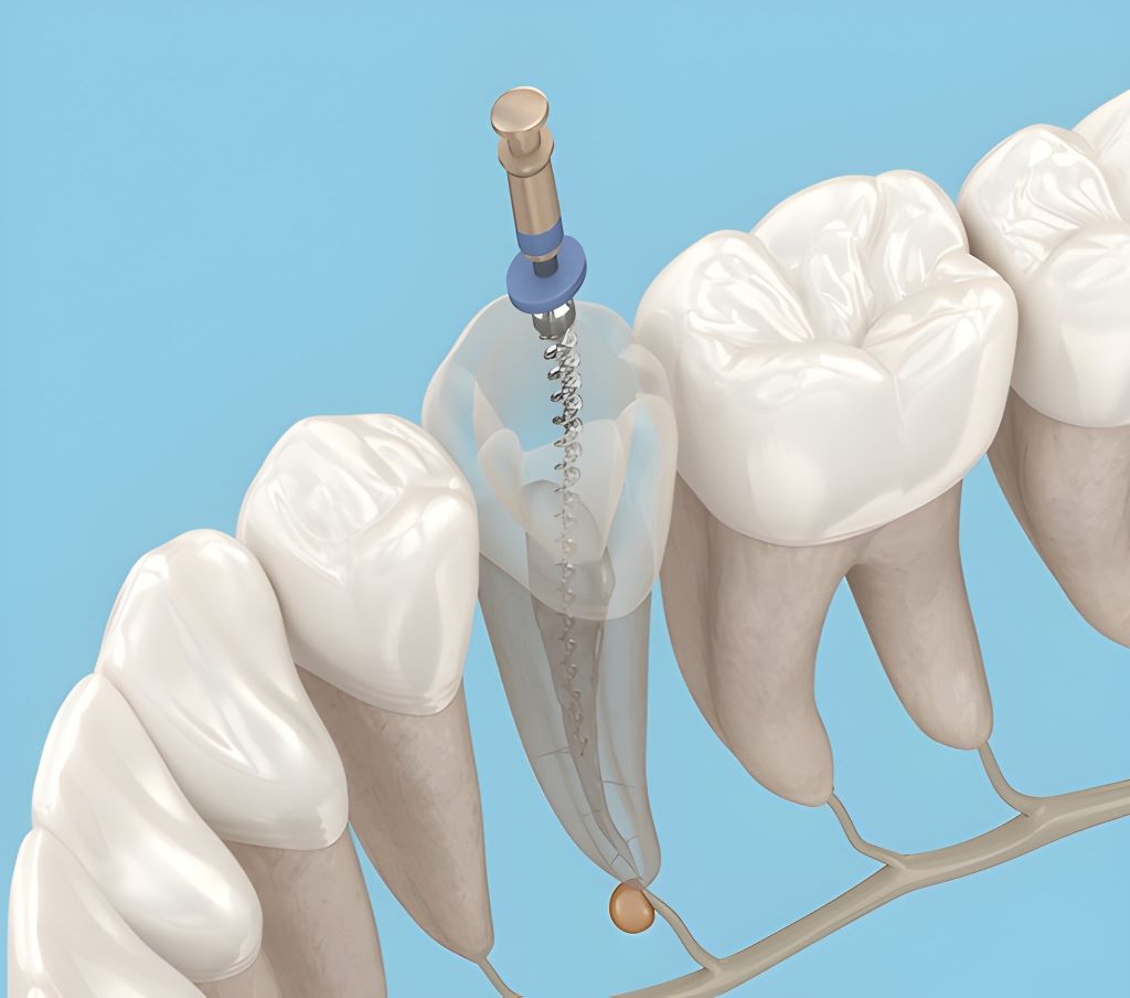 root canal therapy in sw calgary, ab