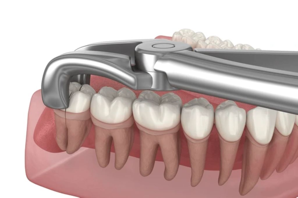 wisdom teeth removal in sw calgary, ab